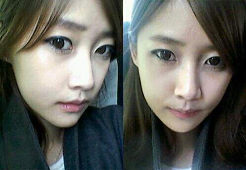 在北京藝星醫(yī)療美容醫(yī)院做下頜角整形手術真實經歷