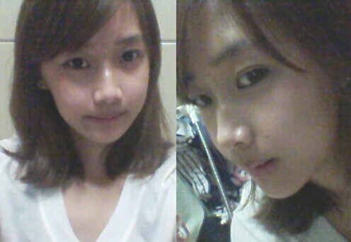 在北京藝星醫(yī)療美容醫(yī)院做下頜角整形手術真實經歷