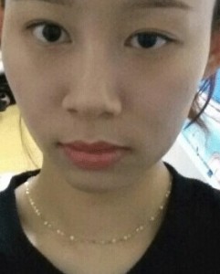 顴骨整形后我也變得甜美了