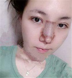 埋線雙眼皮修復(fù)+鼻部修復(fù)歷程