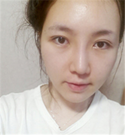 埋線雙眼皮修復(fù)+鼻部修復(fù)歷程