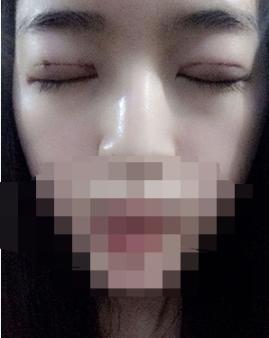 做埋線雙眼皮一周啦~果滿滿的！