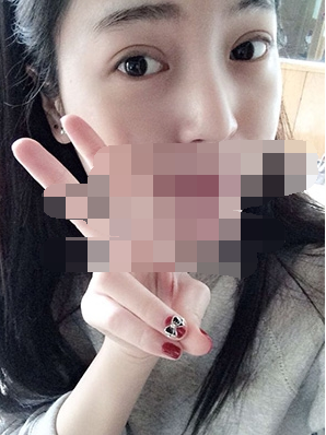 做埋線雙眼皮一周啦~果滿滿的！