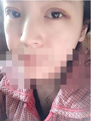 做埋線雙眼皮一周啦~果滿滿的！