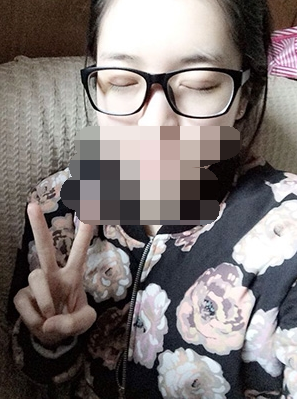 做埋線雙眼皮一周啦~果滿滿的！