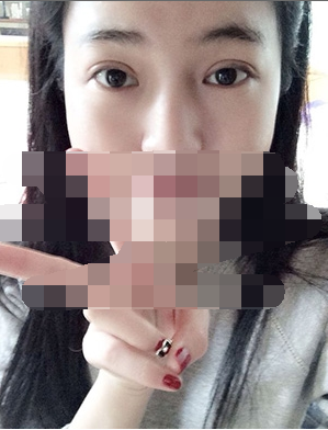 做埋線雙眼皮一周啦~果滿滿的！