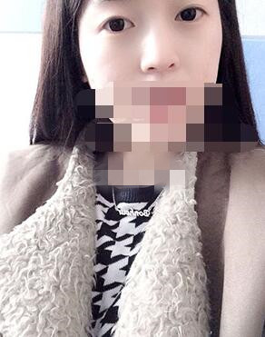 做埋線雙眼皮一周啦~果滿滿的！