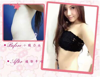 腰腹吸脂 讓我告別海馬腰