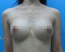 我在北京藝星醫(yī)療美容醫(yī)院自體脂肪隆胸真實(shí)經(jīng)歷