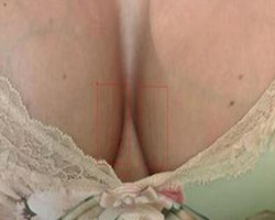 我在北京藝星醫(yī)療美容醫(yī)院自體脂肪隆胸真實(shí)經(jīng)歷