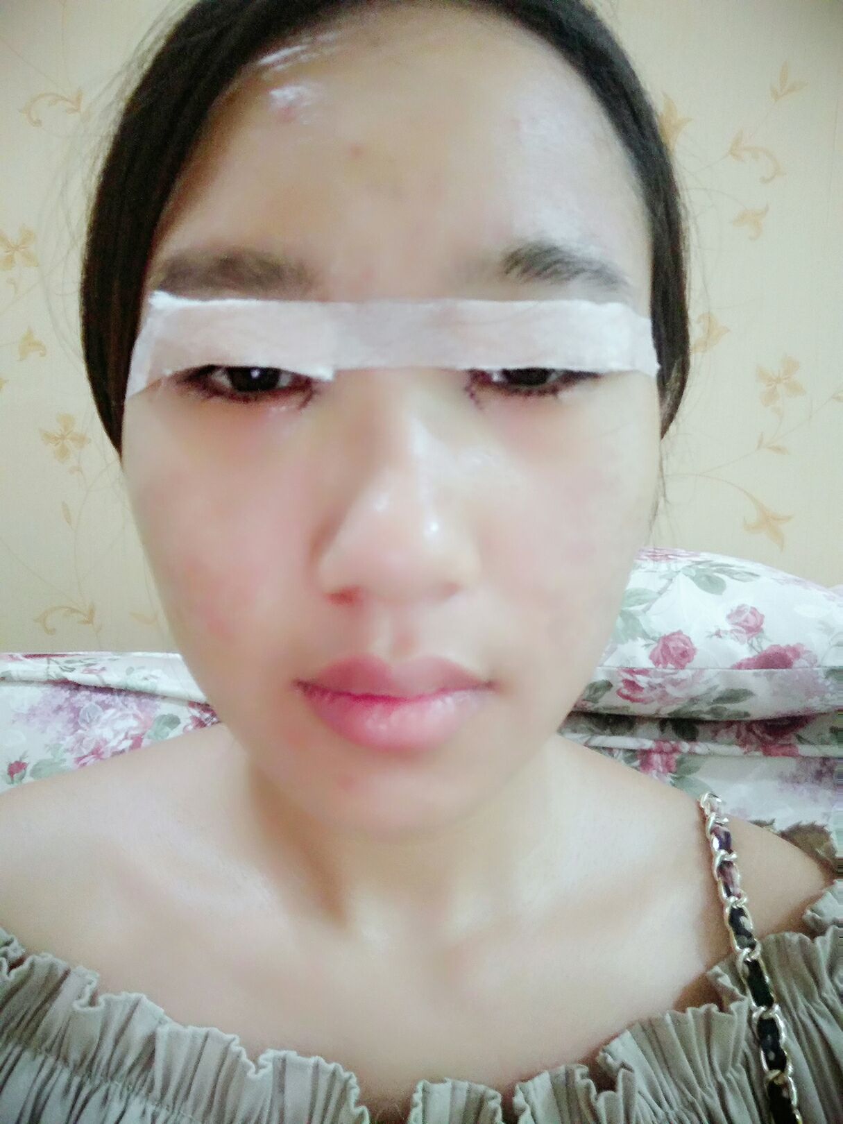 8.15號割的雙眼皮 感謝慕醫(yī)生