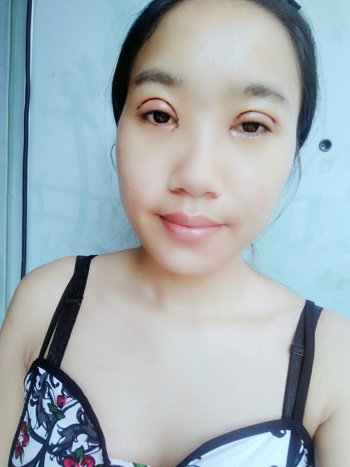 8.15號割的雙眼皮 感謝慕醫(yī)生