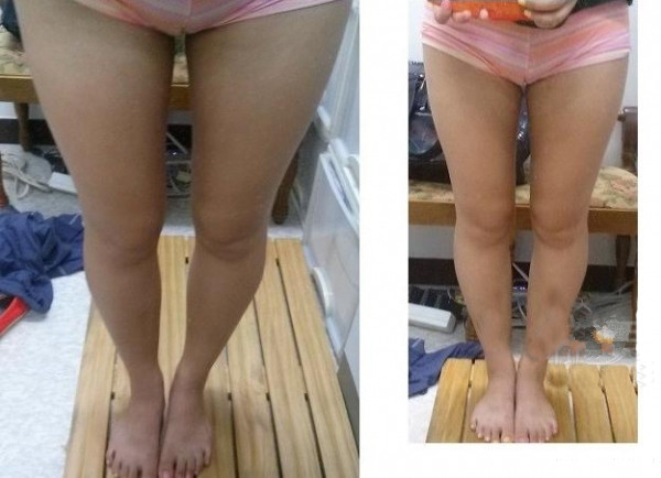 大腿吸脂三個(gè)月 瘦了很多