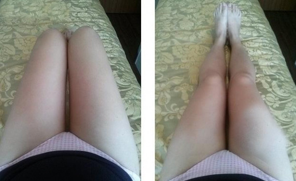 大腿吸脂三個(gè)月 瘦了很多