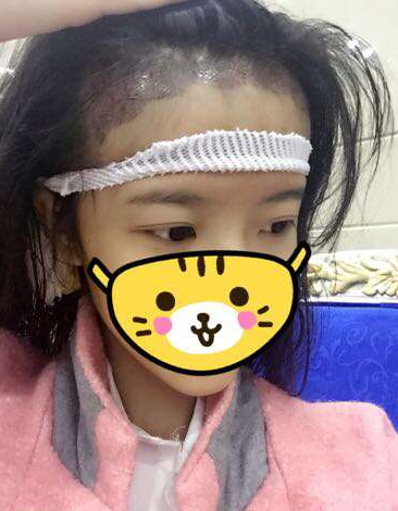 成都玉之光發(fā)際線種植 果不錯~