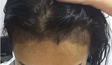 成都玉之光發(fā)際線種植 果不錯~