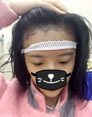 成都玉之光發(fā)際線種植 果不錯~