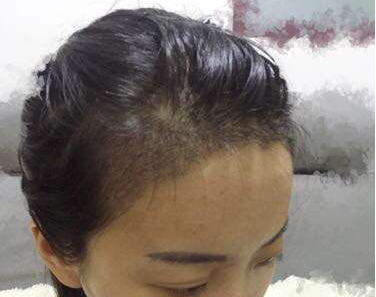 成都玉之光發(fā)際線種植 果不錯~