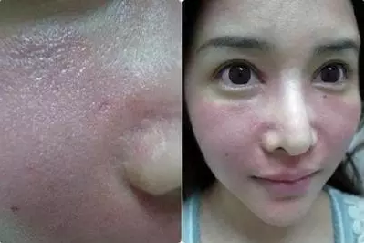 成都玉之光激光嫩膚經(jīng)歷 愛(ài)美的MM一定要看