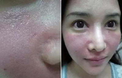 成都玉之光激光嫩膚經(jīng)歷 愛(ài)美的MM一定要看