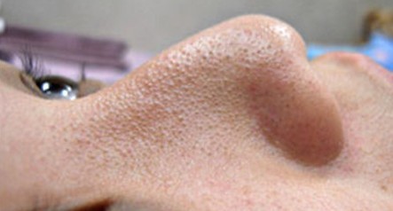 成都玉之光做了杏仁酸換膚 皮膚真的凈白無(wú)瑕了