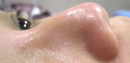 成都玉之光做了杏仁酸換膚 皮膚真的凈白無(wú)瑕了