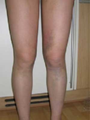 北京禾美嘉大腿吸脂 給大家分享一下體驗