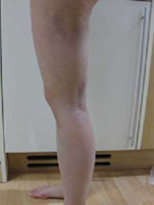 北京禾美嘉大腿吸脂 給大家分享一下體驗