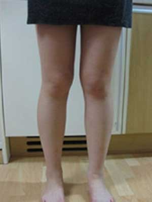 北京禾美嘉大腿吸脂 給大家分享一下體驗