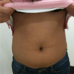 北京禾美嘉腹部吸脂 可以自信地秀出小蠻腰啦!