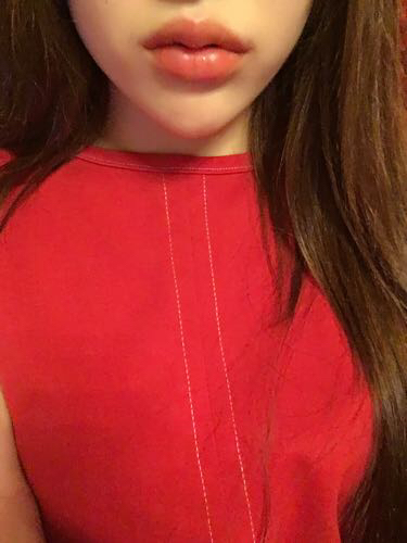 北京禾美嘉注射玻尿酸豐唇+豐臥蠶 讓我更美啦~