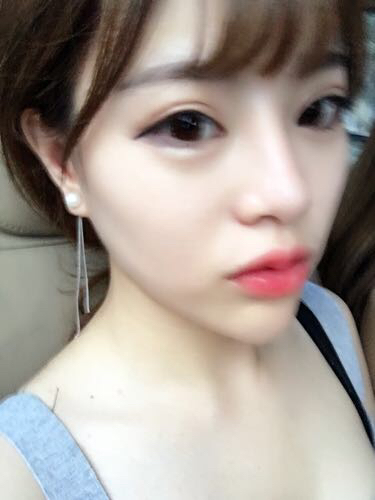 北京禾美嘉注射玻尿酸豐唇+豐臥蠶 讓我更美啦~