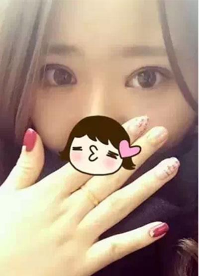 深圳希思做的雙眼皮+開眼角 感謝楊醫(yī)師！