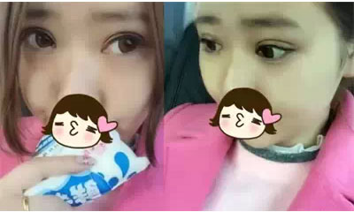 深圳希思做的雙眼皮+開眼角 感謝楊醫(yī)師！