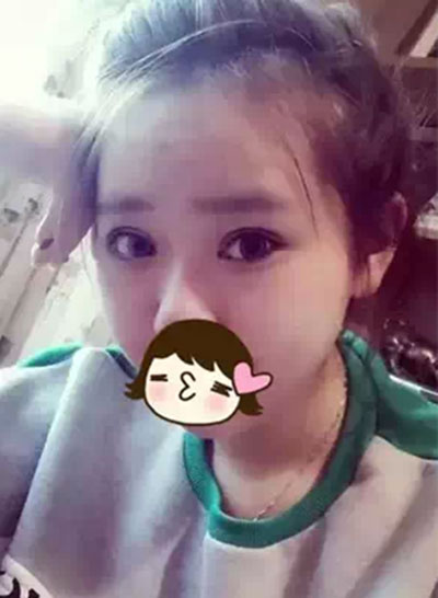 深圳希思做的雙眼皮+開眼角 感謝楊醫(yī)師！