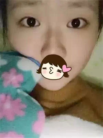 深圳希思做的雙眼皮+開眼角 感謝楊醫(yī)師！