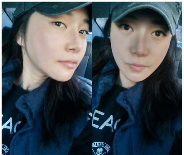 柳大烈給我做的改臉型手術(shù) 求圍觀！