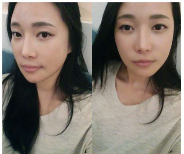 柳大烈給我做的改臉型手術(shù) 求圍觀！