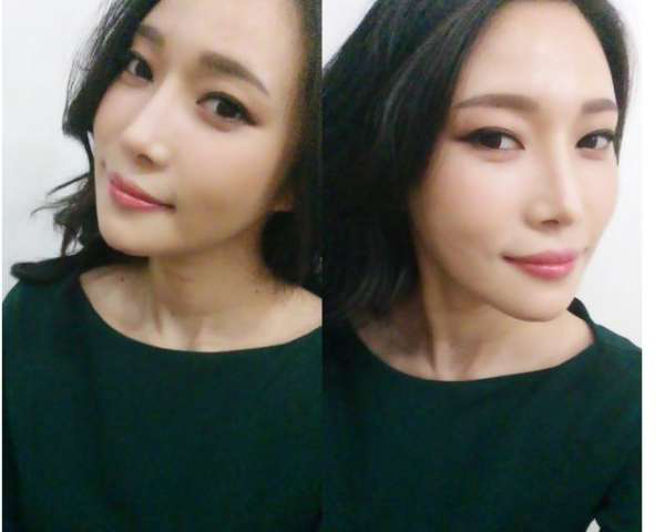 柳大烈給我做的改臉型手術(shù) 求圍觀！