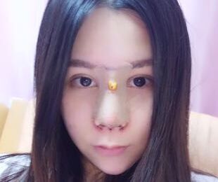 　　以前做過鼻子，但是不好看，山根那個(gè)地方太奇怪了，形狀不太協(xié)調(diào)，聽說趙士俊醫(yī)生做鼻子修復(fù)很好，就慕名而來啦，放心的把自己的鼻子交給他，后來的果沒有讓我失望哦。    　　之前做的鼻子，奇怪吧。    　　做了手術(shù)之后打了消炎針，漏掉一天沒搭，傷口就發(fā)紅泛腫了，簡直嚇人，趕緊去醫(yī)院打消炎，喝白粥度日。    　　沒拆紗布，不過感覺已經(jīng)聽好了，拆了應(yīng)該很好看的。    　　恢復(fù)得不錯(cuò)了，穿了古裝，畫了個(gè)美美的妝，完全沒有違和感。