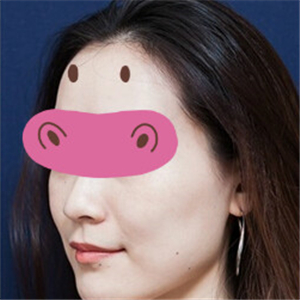 新疆,整形,美容,醫(yī)院,音波,拉皮