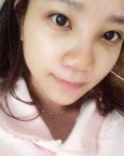 假體隆鼻15天后恢復(fù)果 杭州時(shí)光做的~