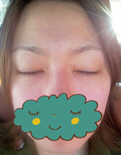 杭州時(shí)光激光去眼袋1個(gè)月了