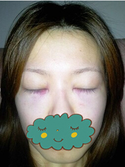 杭州時(shí)光激光去眼袋1個(gè)月了