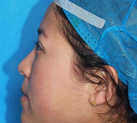 雙眼皮手術讓我單眼皮變雙眼皮就是這么簡單