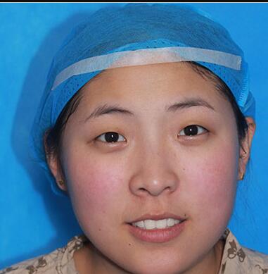 雙眼皮手術讓我單眼皮變雙眼皮就是這么簡單