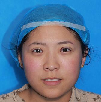 雙眼皮手術讓我單眼皮變雙眼皮就是這么簡單