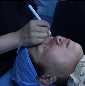 雙眼皮手術讓我單眼皮變雙眼皮就是這么簡單