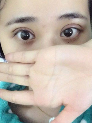 北京常好麗格割雙眼皮一周啦~