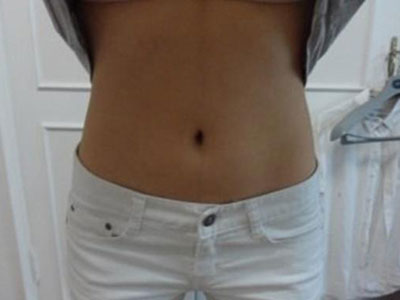 北京常好麗格腰腹吸脂后20天的感受 恢復(fù)日記來(lái)咯~